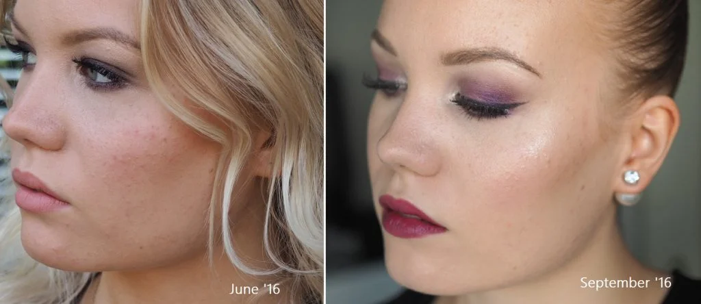 acne progress before and after Acnatac treatment