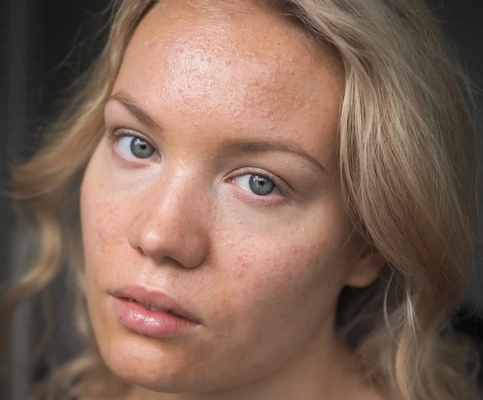 acne skin progress photo