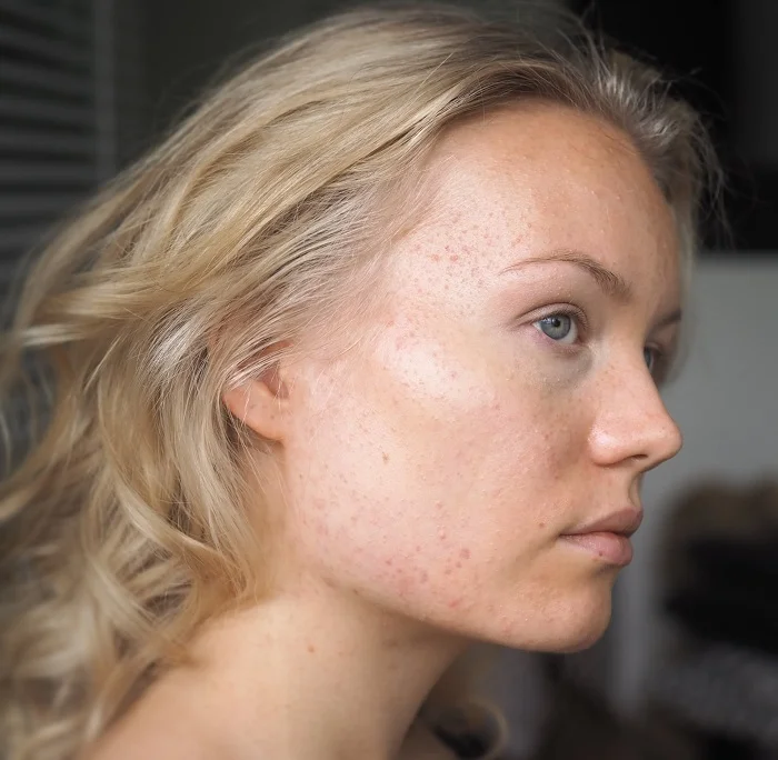 acne how I cured it