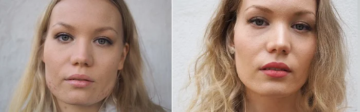 ennen jälkeen botox