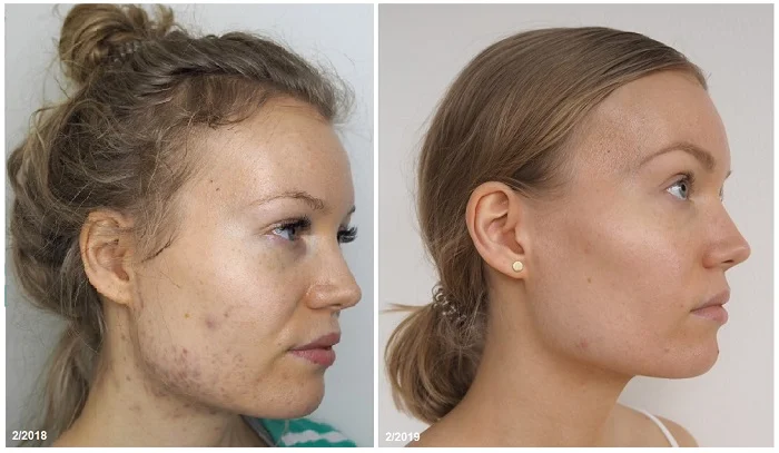 acne a year apart