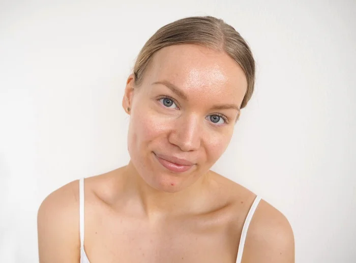 skin update after acne