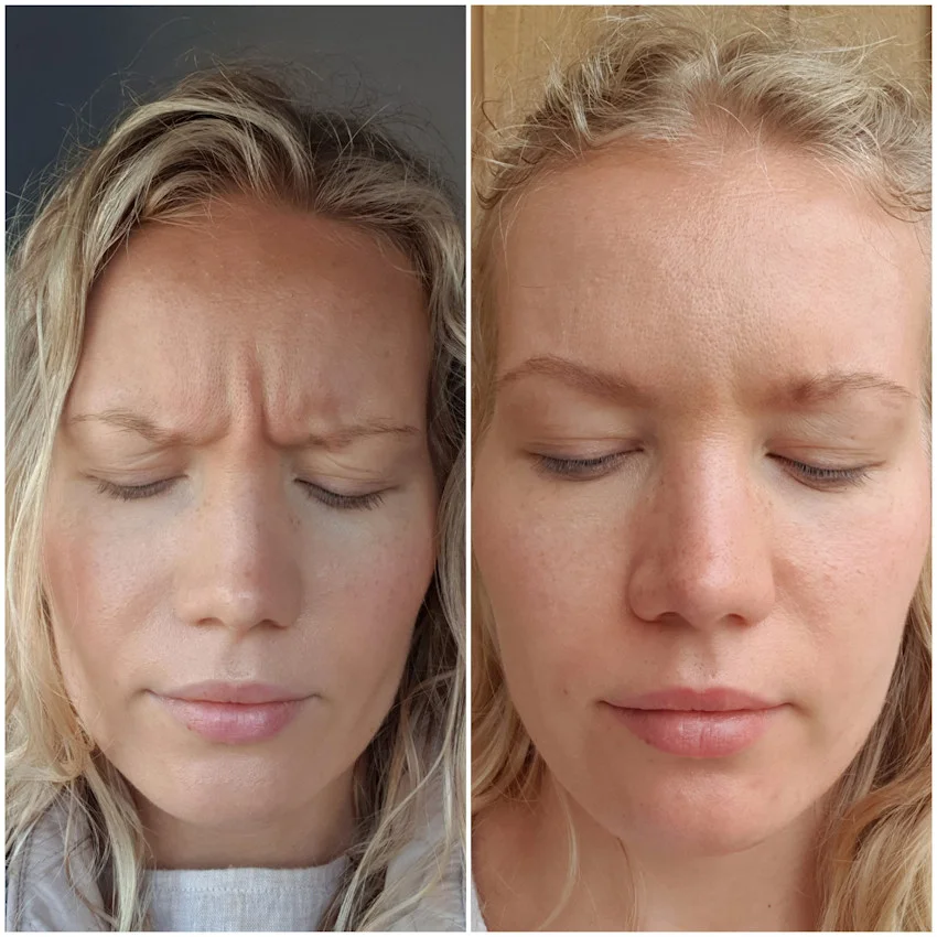botox for frown lines before and after