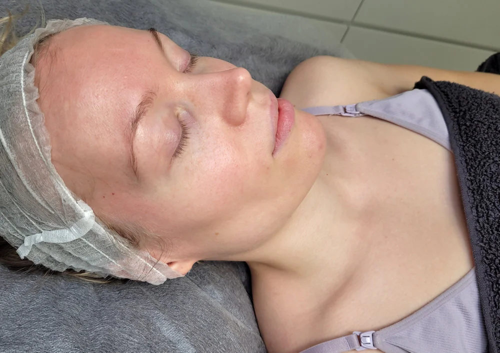 Skin Before Microneedling
