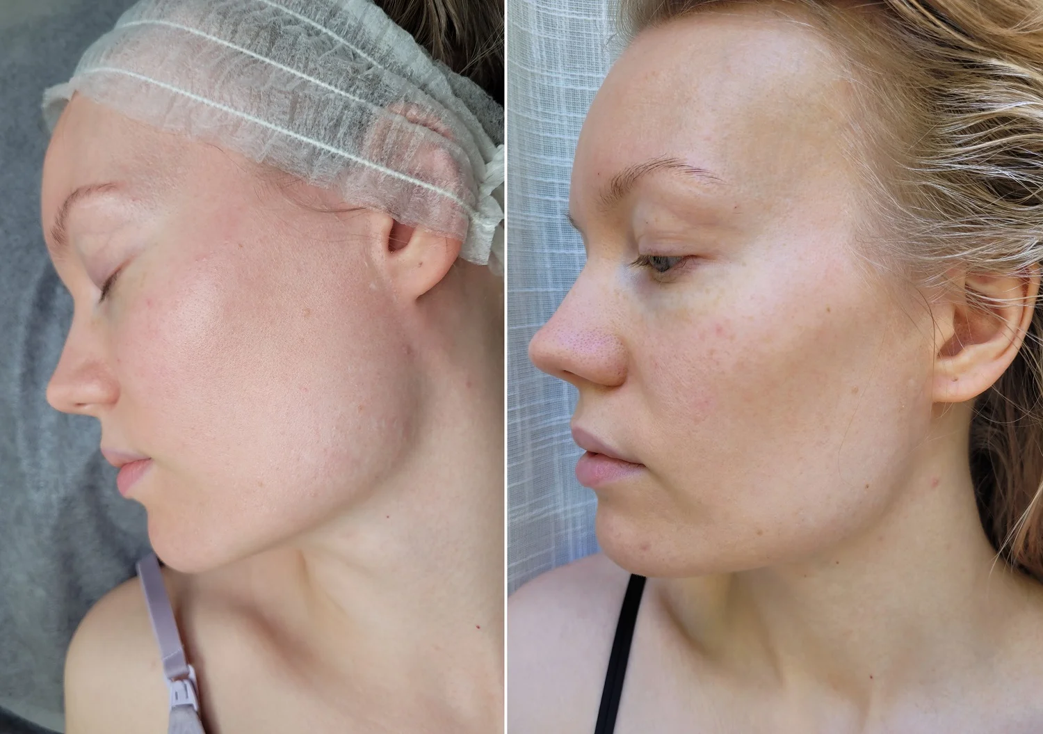 Ennen ja jälkeen neljän Dermapen-mikroneulaushoidon