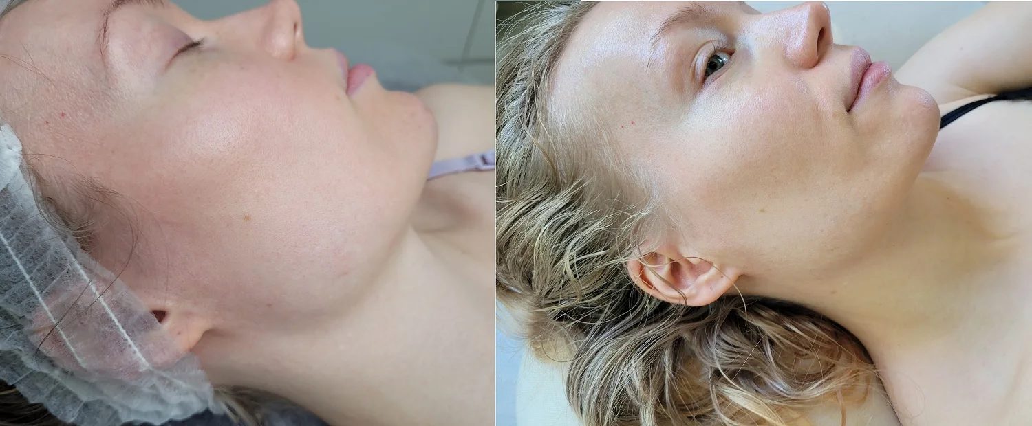 Dermapen-mikroneulauksen ennen-jälkeen-tulokset sivulta