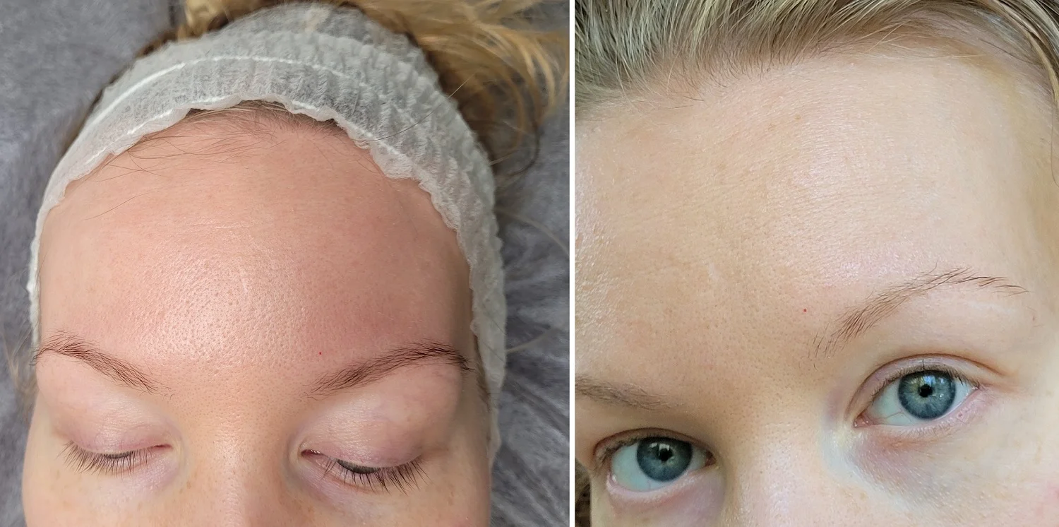 Ihon tekstuuri neljän Dermapen-mikroneulaushoidon jälkeen