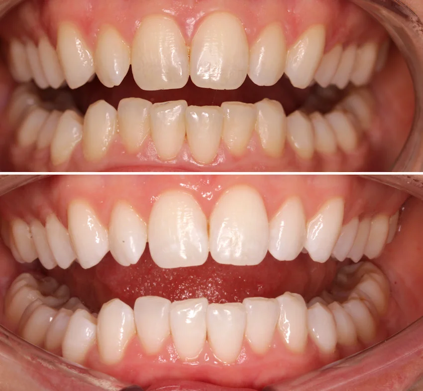 before after teeth whitening ebeling